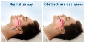 Sleep Apnea