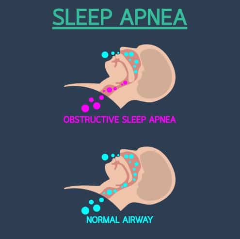 sleep apnea diagram Sleep Apnea Castle Rock Dr. Aaron Goodman Dr. Matthew Young Dr. Aaron English. Prairie Hawk Dental. General, Cosmetic, Restorative, Preventative Family Dentistry. Dentist in Castle Rock, CO 80109