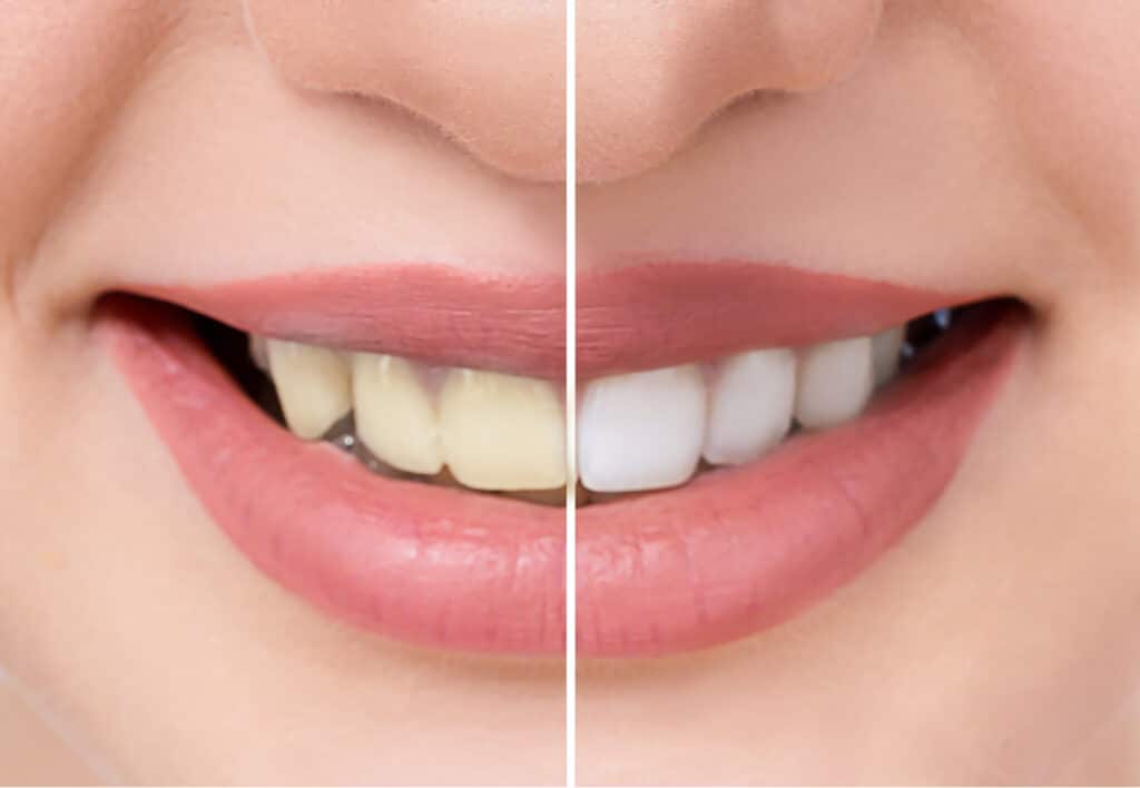 before and after teeth whitening Cosmetic Dental Procedures in Castle Rock, CO Dr. Aaron Goodman Dr. Matthew Young Dr. Aaron English. Prairie Hawk Dental. General, Cosmetic, Restorative, Preventative Family Dentistry. Dentist in Castle Rock, CO 80109