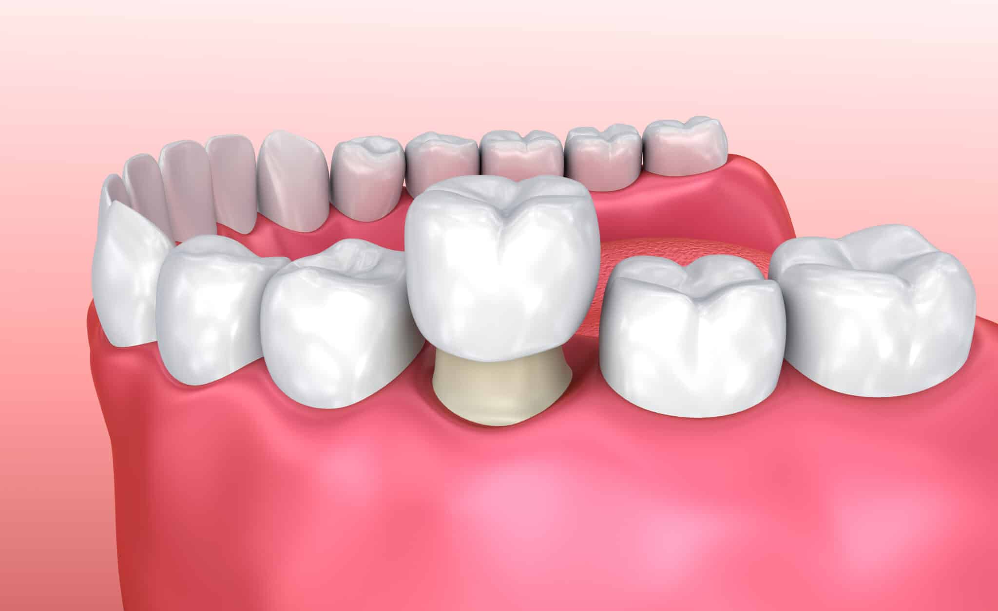 Cosmetic Dental Procedures in Castle Rock, CO Dr. Aaron Goodman Dr. Matthew Young Dr. Aaron English. Prairie Hawk Dental. General, Cosmetic, Restorative, Preventative Family Dentistry. Dentist in Castle Rock, CO 80109dental crowns